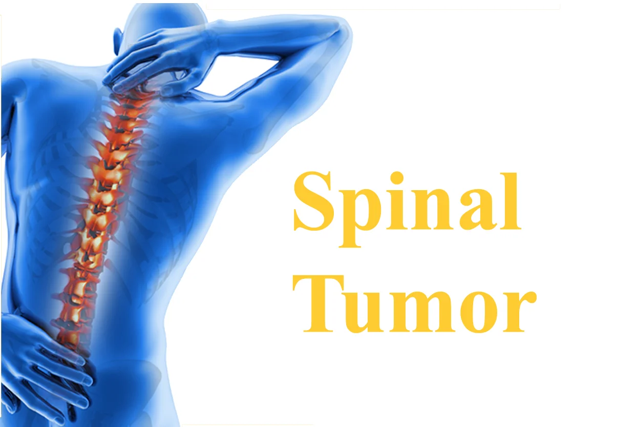 Spinal Tumors