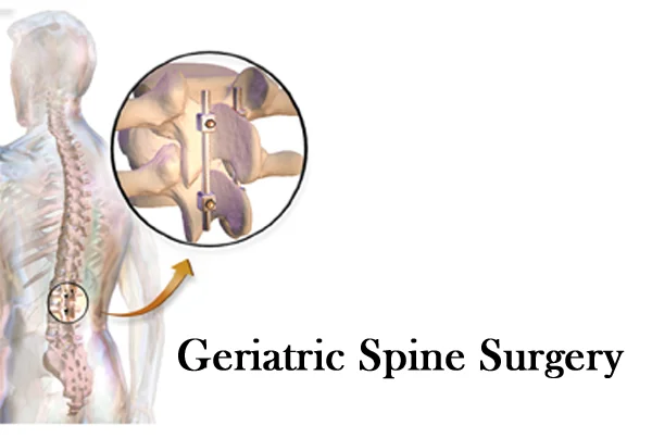 Geriatric Spine Surgery