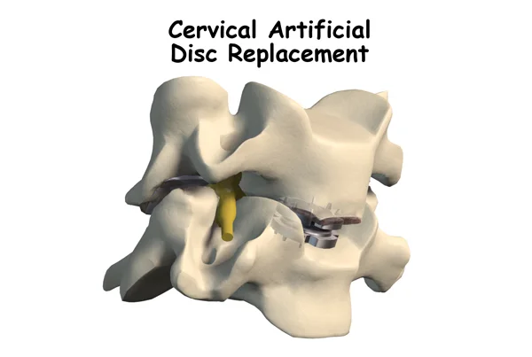 Artificial Disc Replacement