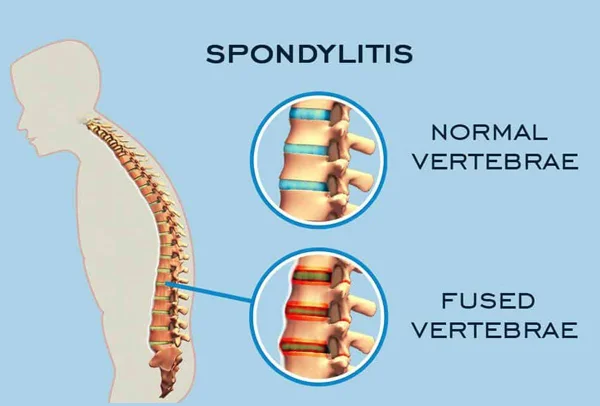 Spondylolisthesis