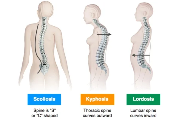 Spinal Deformitites