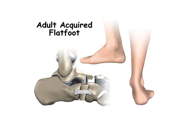 Adult Degenerative Deformity